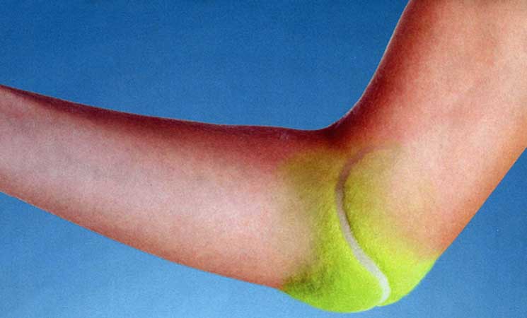 Tennis Elbow