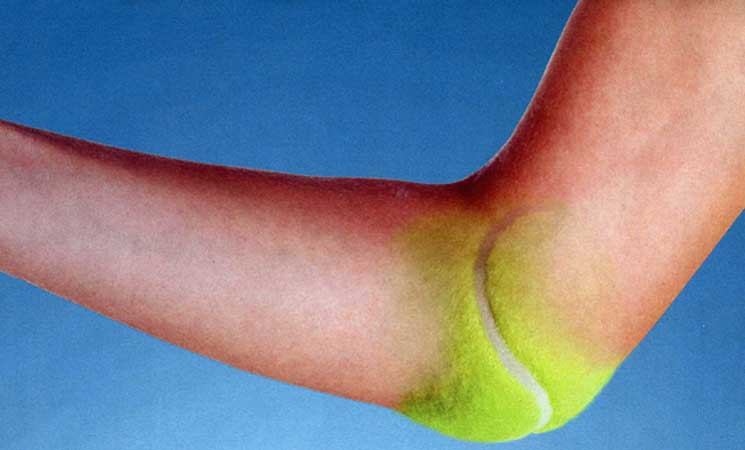 Image result for tennis elbow
